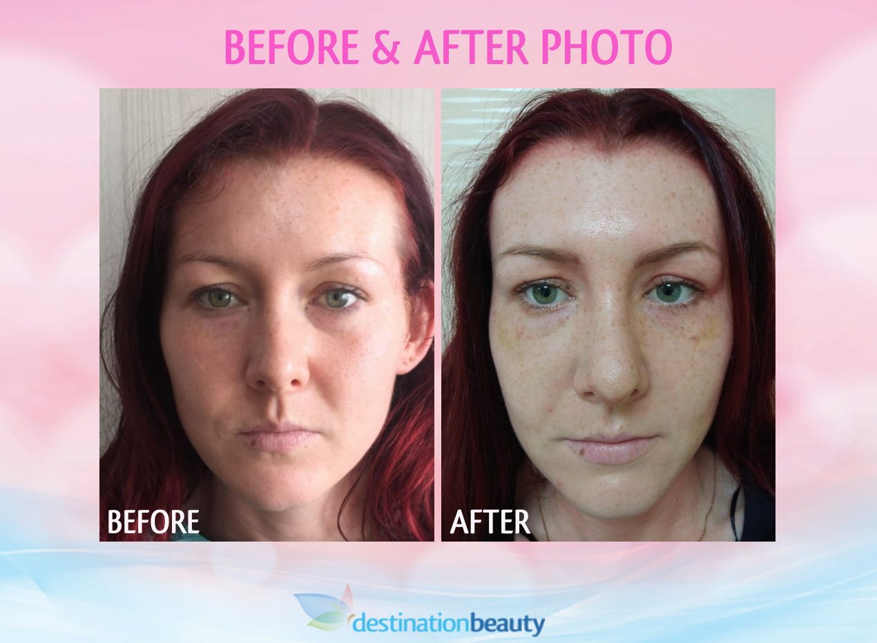 Gemma's nose reshaping in Bangkok with Dr. Supasid!